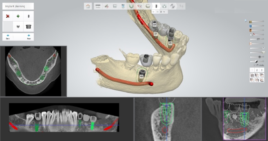 Digitális fogászati vizsgálat fogtérkép röntgen eredmény