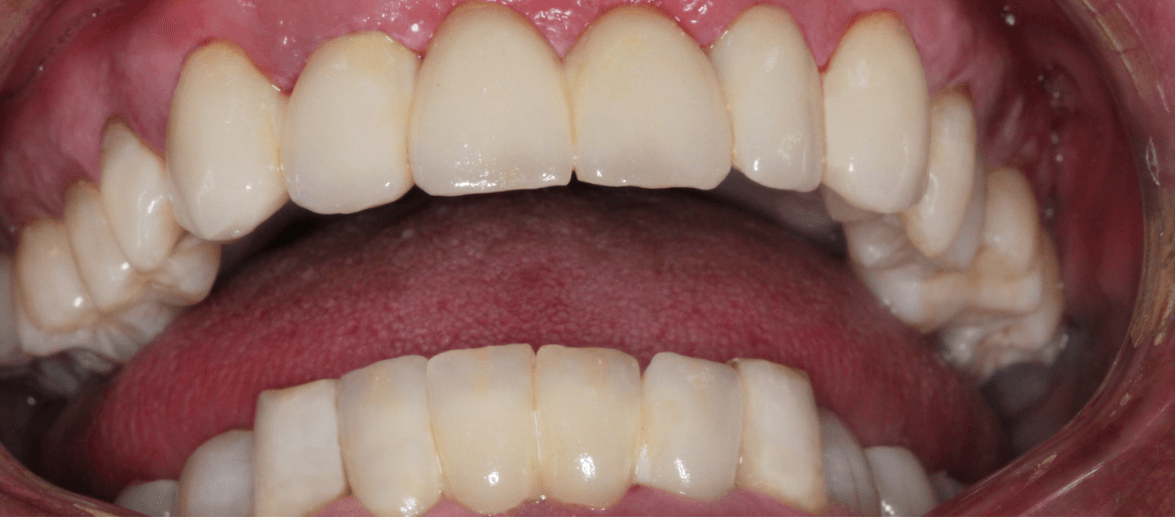 Esetbemutatás: dohányzás által károsított fogak helyreállítása - utána