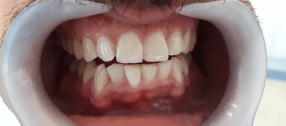 Páciensünk fogsora fogszabályozó kezelés után. Fogszabályozás foghúzás nélkül esetünk.