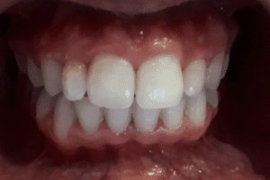 Esetbemutatás: fogszabályozás keresztharapás - utána