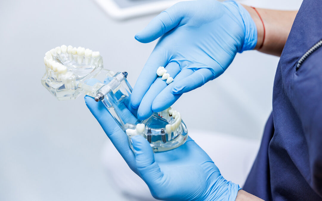 Fogpótlás híddal vagy implantátummal – melyik éri meg jobban hosszú távon?