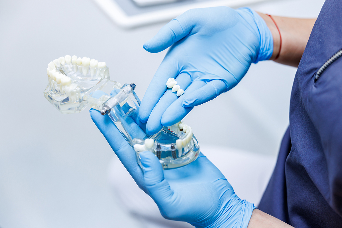 artdent-hid-vagy-implantatum-hero Fogpótlás híddal vagy implantátummal – melyik éri meg jobban hosszú távon? | Artdent Fogászat és Szájsebészet blog