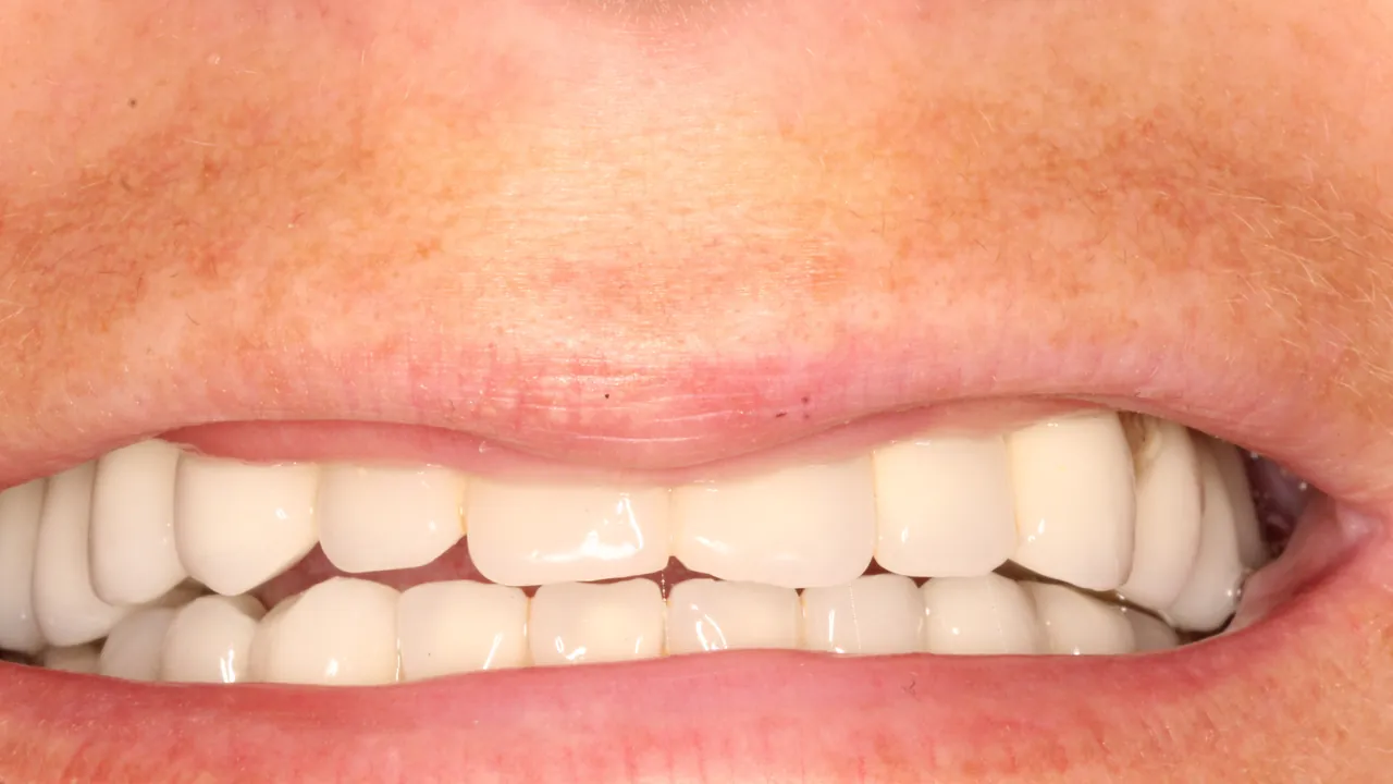 artdent-esetbemutatas-all-on-4-borito Implantátumokra rögzített felső és alsó fogpótlás az Artdent All-on-4 esetbemutatójában.