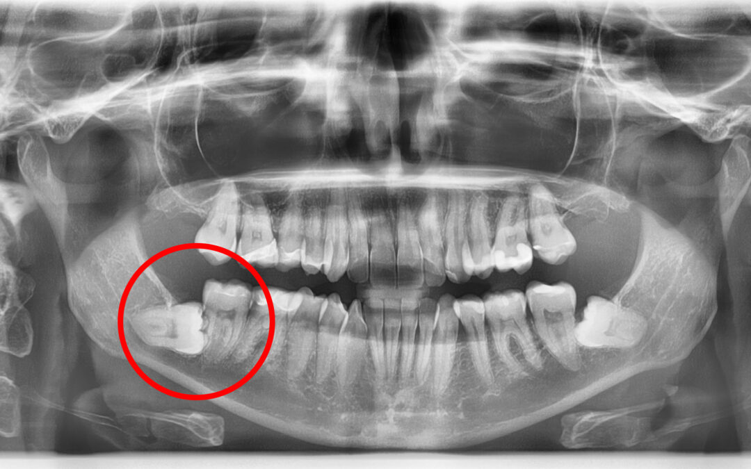 Fekvő, idegre simuló bölcsességfog – így terveztük meg a műtétet 3D CT-vel